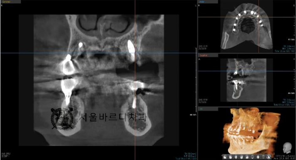 상일동역치과 서울바르디치과 무절개 네비게이션 임플란트 치료증례 #5 관련 이미지 12