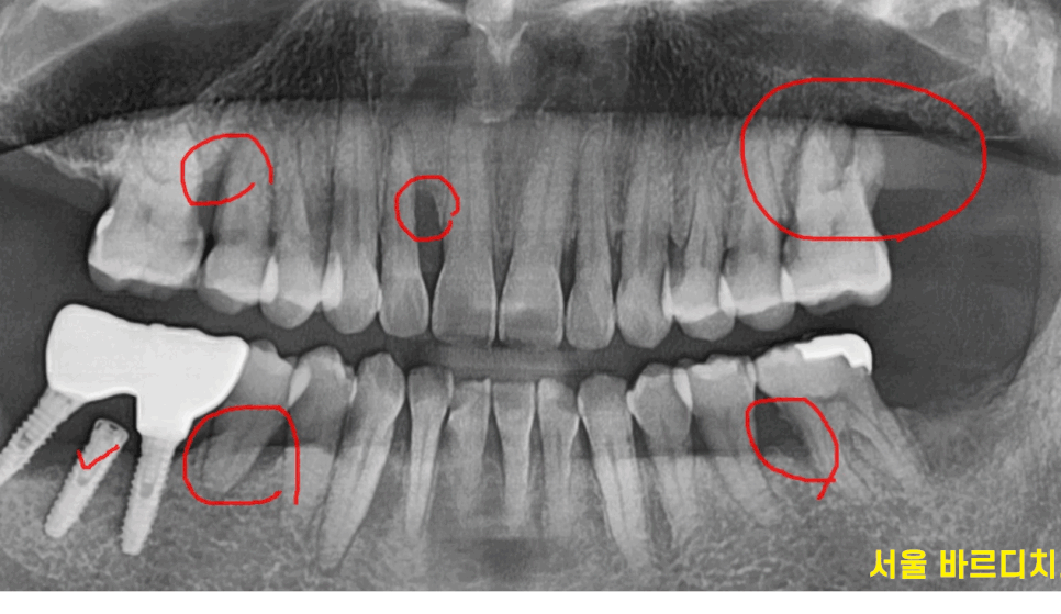 잇몸 고름 냄새 약으로 없앨 수는 없나요? 무시 무시한 치주염 관련 이미지 1