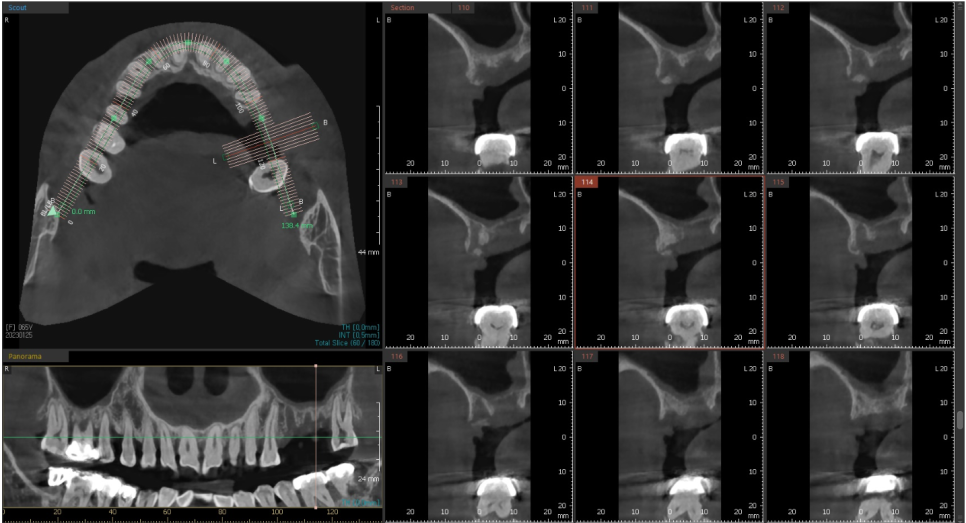 고덕동치과 서울바르디치과 무절개 네비게이션 임플란트 치료증례 #2 관련 이미지 11