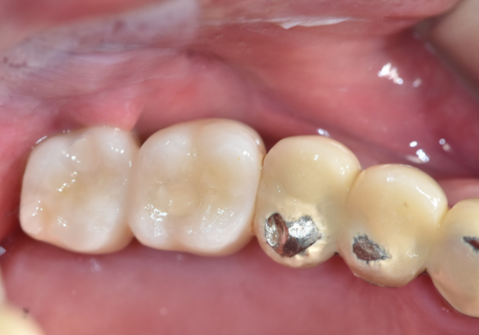명일동 치과, 잇몸이 검게 변했다면? 앞니 변색 원인은 바로 관련 이미지 2