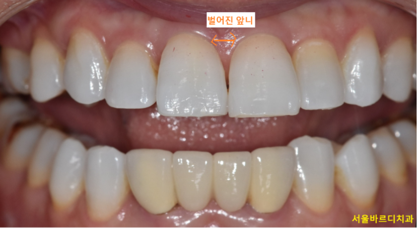 상일동 근처 교정 다시 삐뚤어진 치아 치료하기 관련 이미지 2