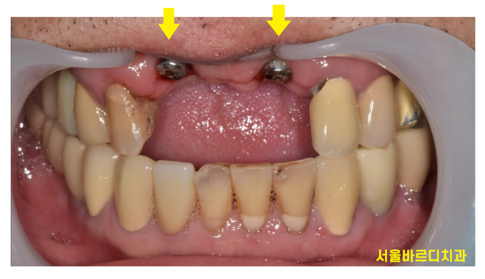 상일동역 치과 부러진 앞니 임플란트로 복구하기 프로젝트 관련 이미지 8