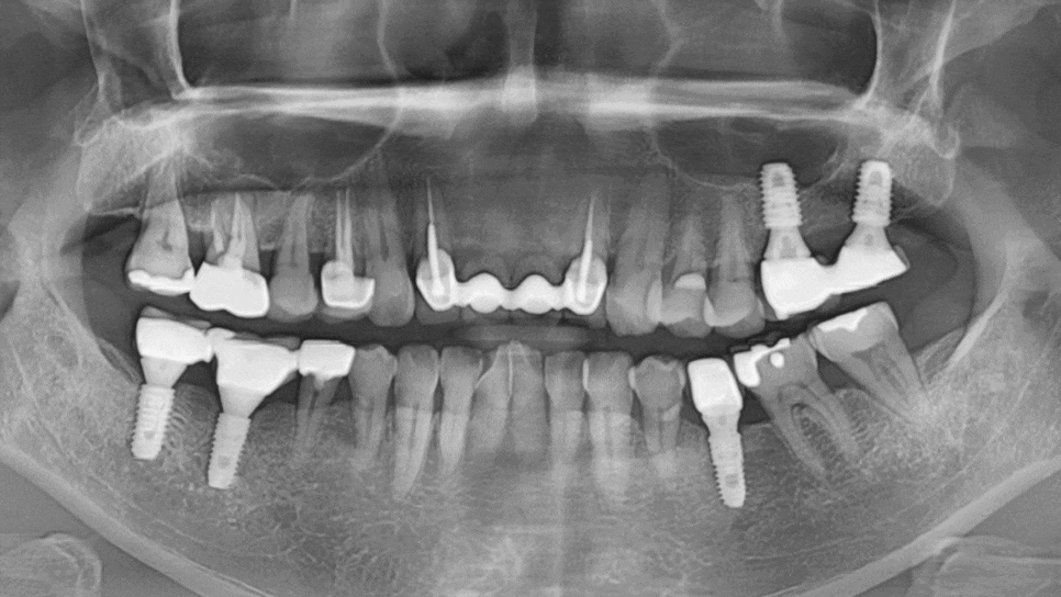 명일동 앞니 브릿지, 새로 교체 할 때 꼭 확인해 봐야 할 관련 이미지 4