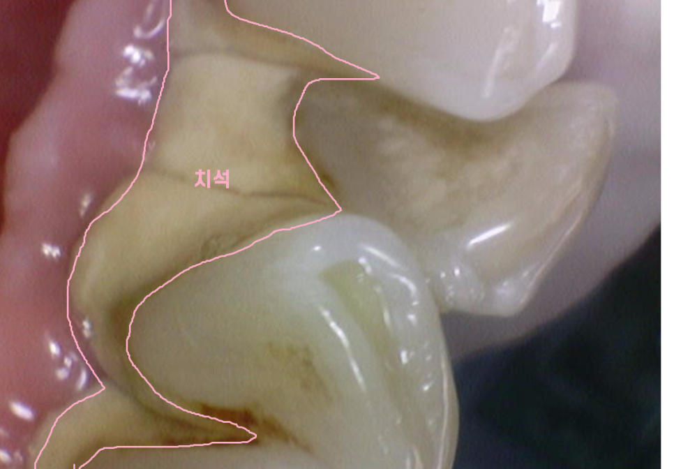망월동 치과 어금니 빠짐 임플란트 대안이 될 수 있습니다. 관련 이미지 5