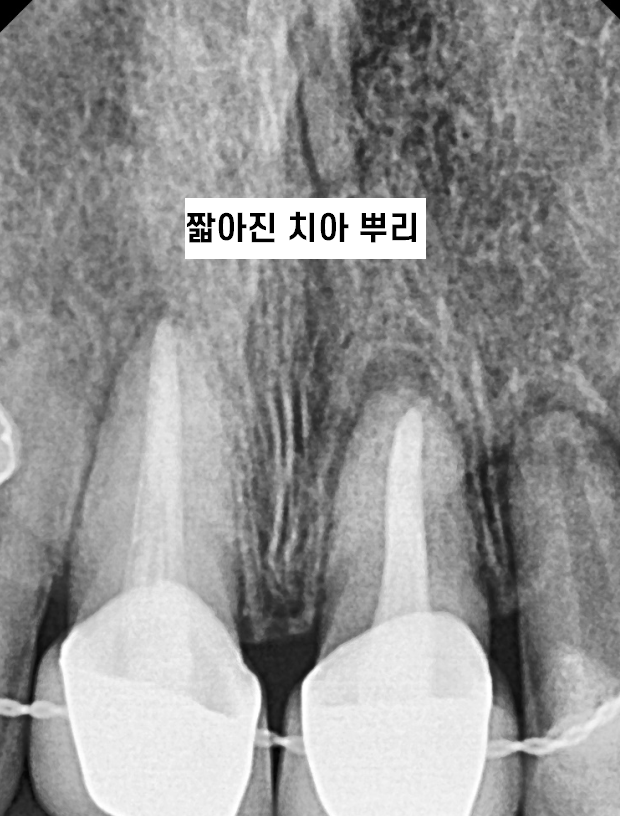 상일동역 치아교정 부작용 꼭 알아보고 대처하세요!!! 관련 이미지 1