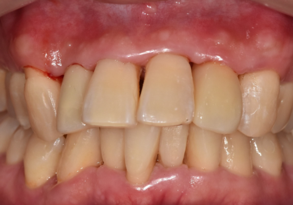 강동구 앞니 충치, 누구는 레진이고 누구는 임플란트인 관련 이미지 18