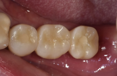 오래된 어금니 롱브릿지, 교체 타이밍을 놓치면 관련 이미지 17