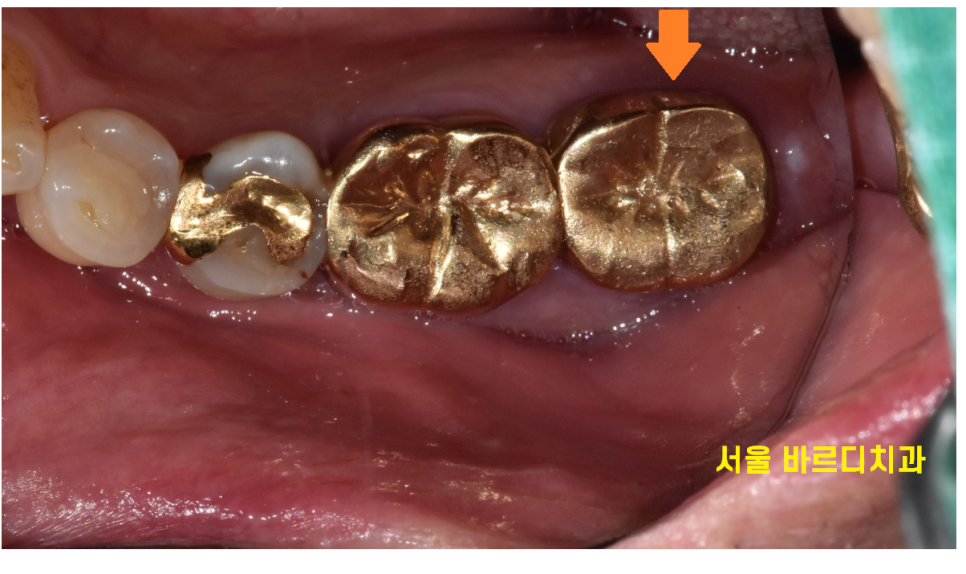 천호동 임플란트 치아 뿌리 충치가 파절을 유발하다. 관련 이미지 4
