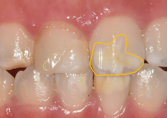 강동구 라미네이트, 치아 하얀 반점 없애고 싶다면? 치료 방법 관련 이미지 3