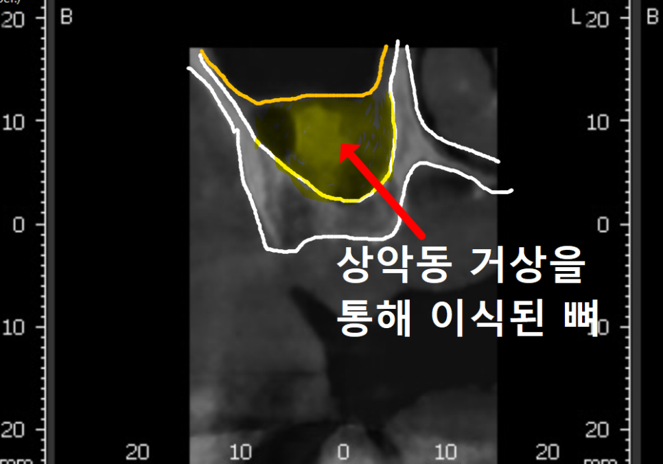 강동구 잇몸 퇴축으로 뿌리 드러난 치아, 이대로 둬도 괜찮을까? 관련 이미지 15