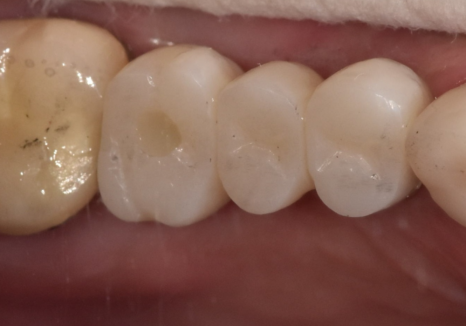 강동구 오래된 보철, 교체 시기는? 아프지 않은데 꼭 바꿔야 하나요? 관련 이미지 10