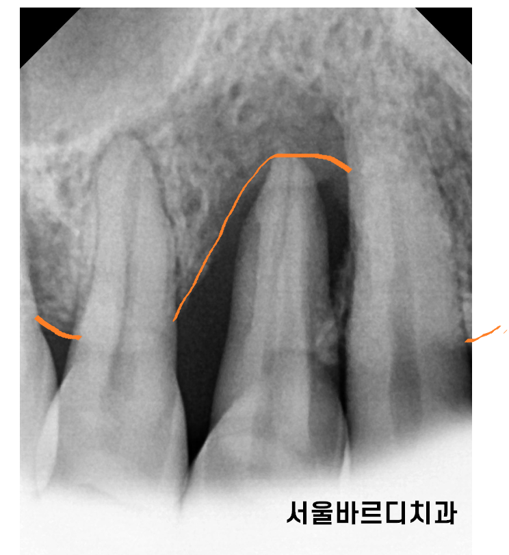 상일동역 치과 잇몸 뼈 녹음 임플란트 케이스 관련 이미지 3