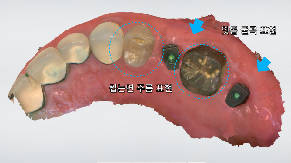 서울바르디치과 뿌리 끝 염증 심한 치아를 네비게이션 임플란트 #6 관련 이미지 16
