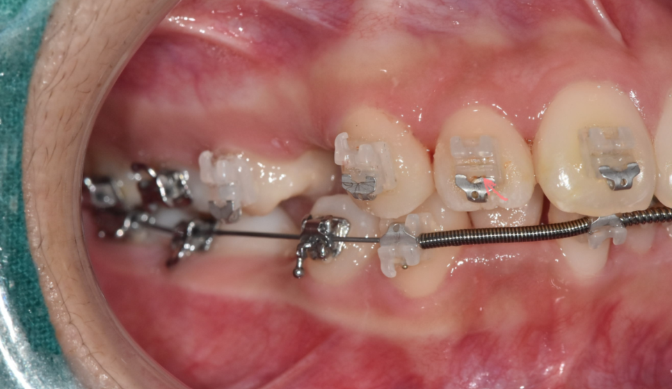 자가결찰 브라켓 빠르게 끝내고 통증은 줄여서 관련 이미지 4