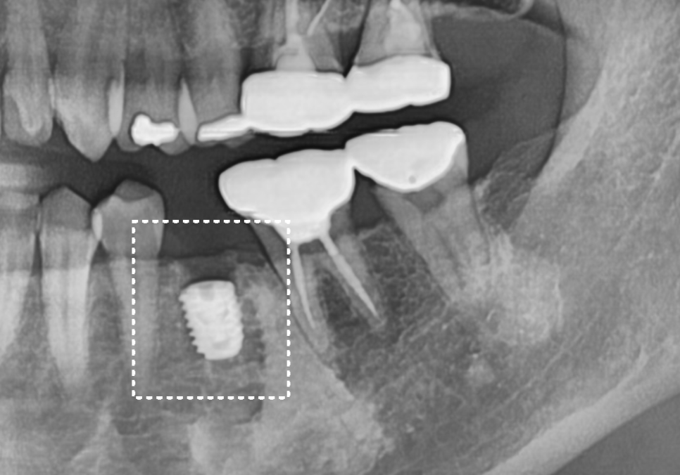 아말감 파절, 조금 깨졌을 뿐인데, 2차 충치로 치아 절반이 깨진 사연 관련 이미지 8