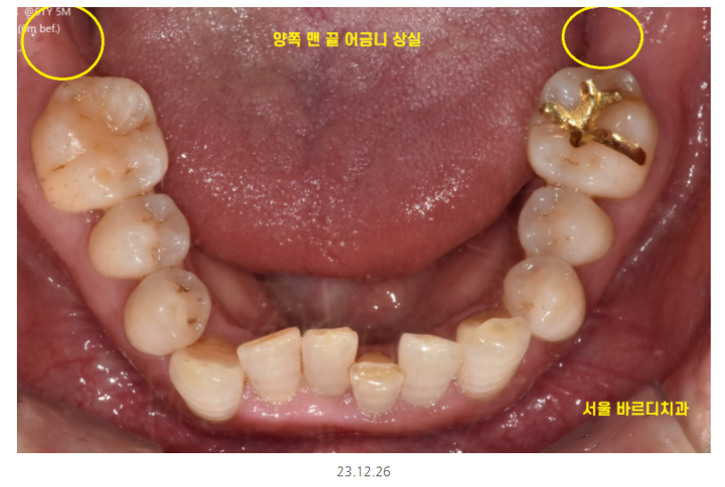 하남시청치과 내비게이션 임플란트 뭐가 좋아요?? 관련 이미지 3