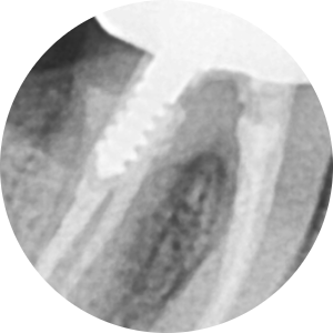Implant treatment is needed when a gum pimple or pus appears. image 6