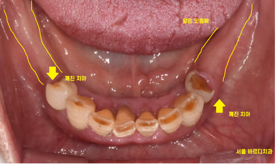 암사동 치과 전악 임플란트 하루만에 끝냈습니다. 관련 이미지 4
