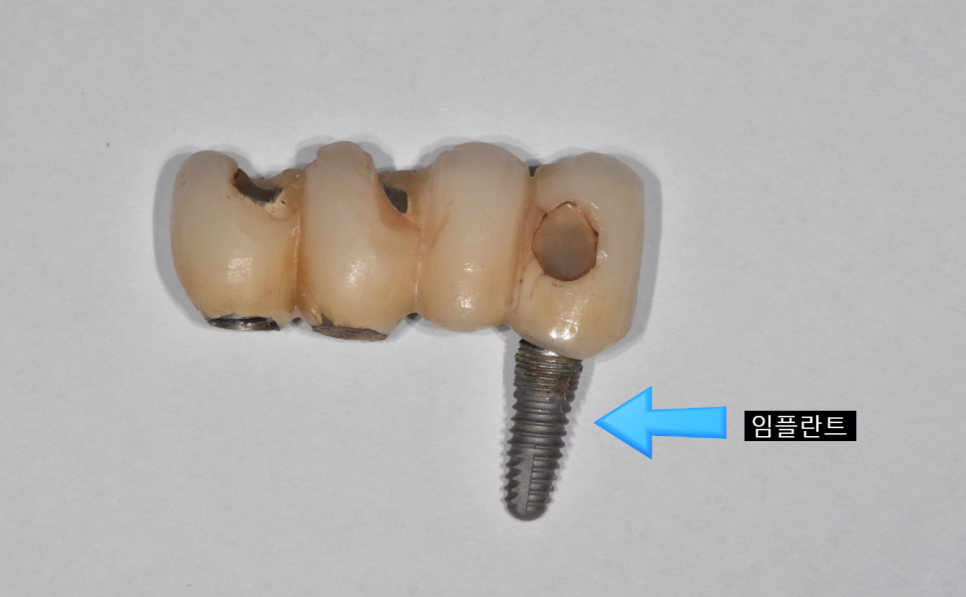 임플란트 잇몸 염증 반복되면 재수술도 필요합니다. 관련 이미지 3