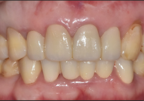 Gangdong-gu Dental Impressions: Are You Still Biting Down for 5 Minutes? We’ll Make It Comfortable with an Intraoral Scanner! image 13