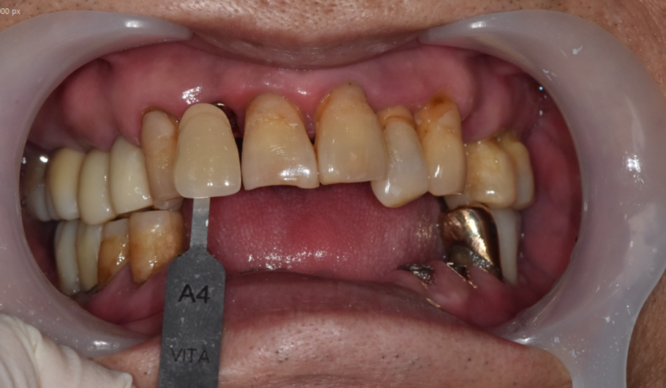 강일동 임플란트 위아래 치아 흔들림과 통증이 있을 때 방법은? 관련 이미지 9