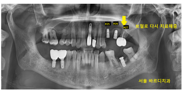 고덕역 근처 치과 브릿지와 임플란트 고민 중이신 분들 클릭하세요 관련 이미지 8