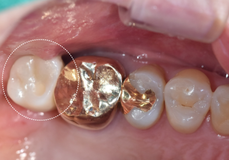 강동구 잇몸 퇴축으로 뿌리 드러난 치아, 이대로 둬도 괜찮을까? 관련 이미지 16