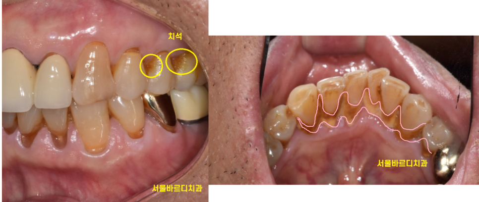 감일동 치과 어금니 시림 충치가 아닐 수도 있다? 임플란트 하게된 사연 관련 이미지 3