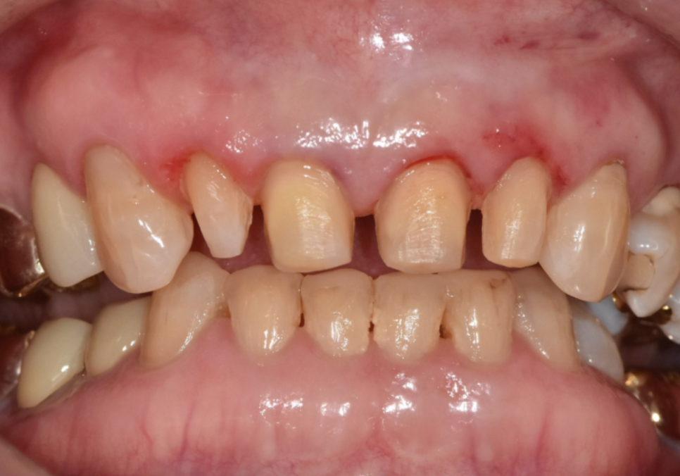 중장년 라미네이트, 70대도 가능한가요? 왜소치와 벌어진 앞니 해결 사례 관련 이미지 11