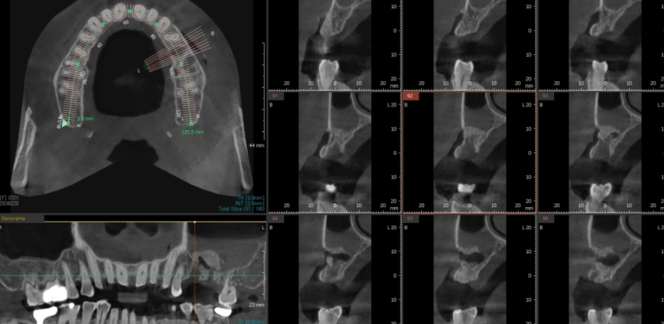 치아 쪼개짐으로 상악동 거상술 동반한 임플란트 수술 관련 이미지 8