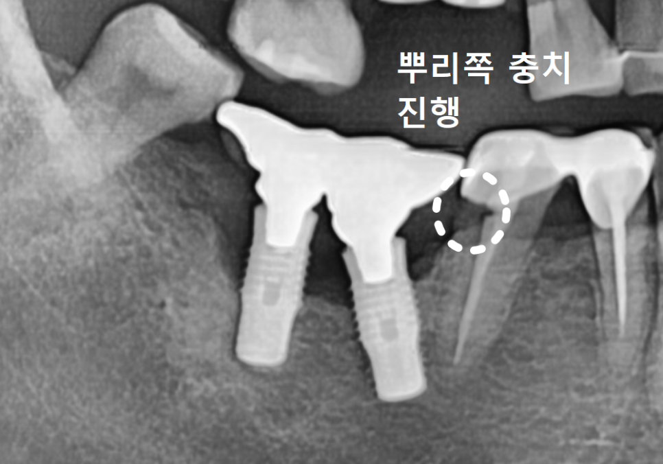 오래된 임플란트, 흔들림과 통증, 어떻게 하면 더 건강하게 쓸 수 있을까? 관련 이미지 9