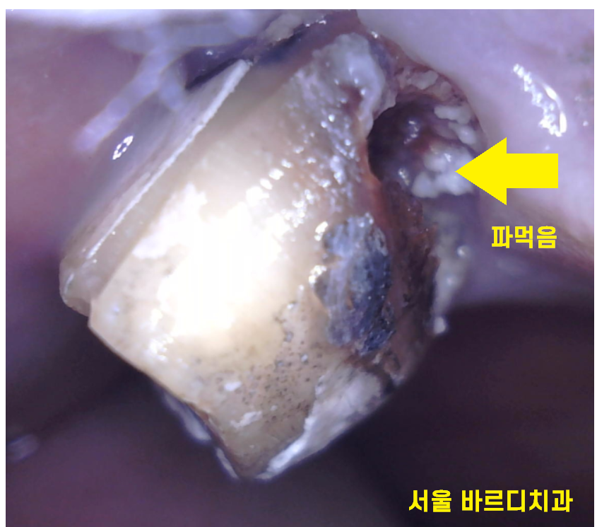 고덕동 치과치료 씌운 치아 문제가 생겼어요 관련 이미지 4