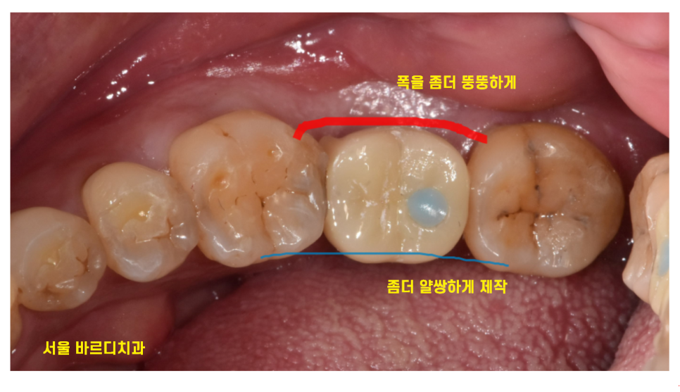 천호동 치과 충치로 인하여 손상된 치아 임플란트로 대처하기 관련 이미지 7