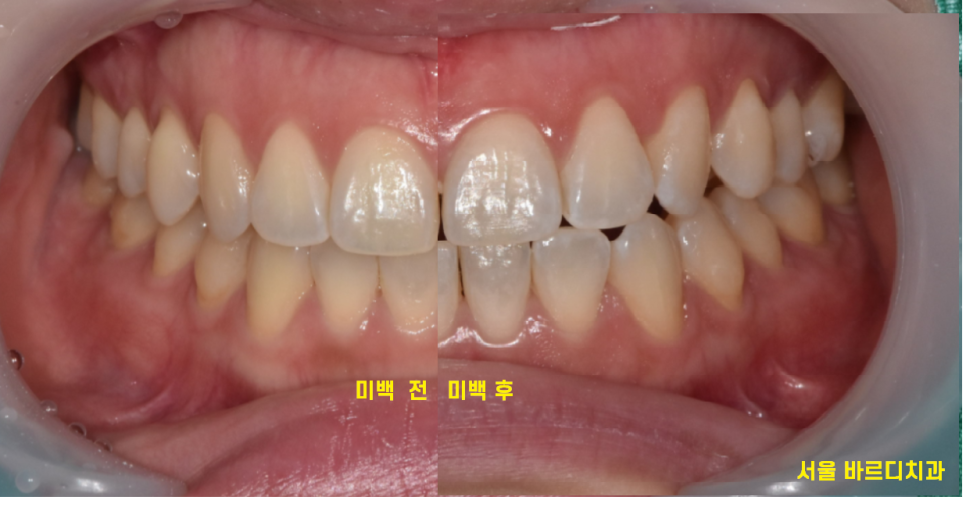 치아미백치료 연예인 같은 치아 나도 될 수 있을까? 팩폭해드릴께요 관련 이미지 3