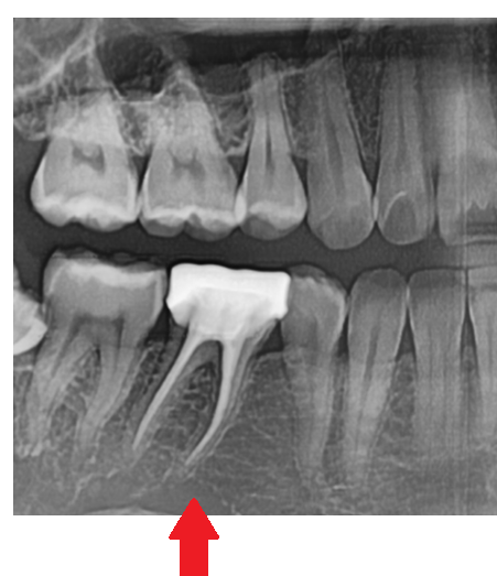어금니 치아 파절 부러짐 발치까지 이어질 수 있습니다. 관련 이미지 4