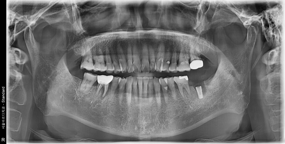 바르디 임플란트는 바르게 심지만, 빠르게 씹습니다. 그간의 경험을 바탕으로요. 관련 이미지 7