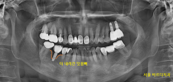 풍산동 치과 임플란트 염증으로 교체 한 환자분 케이스 관련 이미지 3
