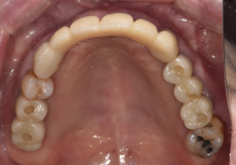 뿌리만 남은 치아, 그대로 두면 왜 위험할까요? 고덕동 전체 임플란트 재건 사례 관련 이미지 17