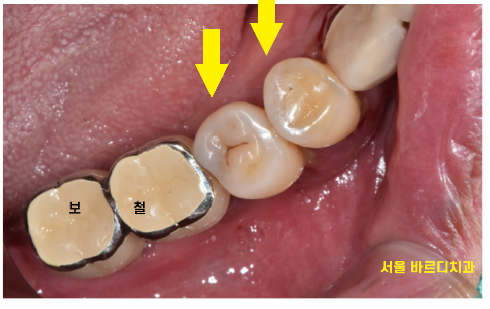 덕소 치과 발치 후 당일 뼈이식의 중요성 설명드립니다!! 관련 이미지 3
