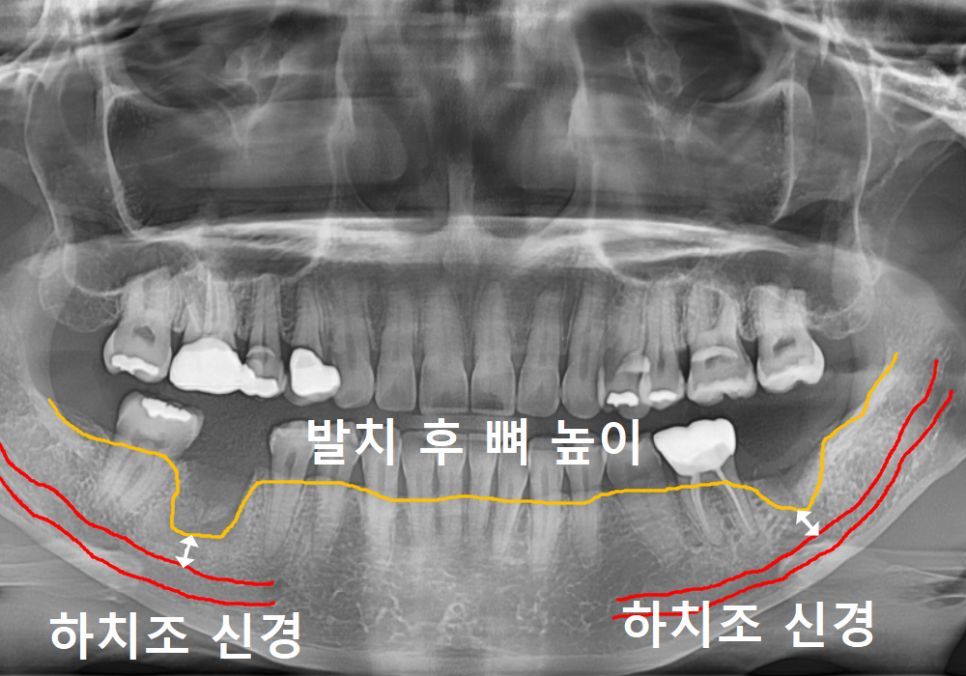 고덕역 임플란트, 뼈이식 꼭 해야 할까? 필수 상황 vs 제외 상황 총정리 관련 이미지 10