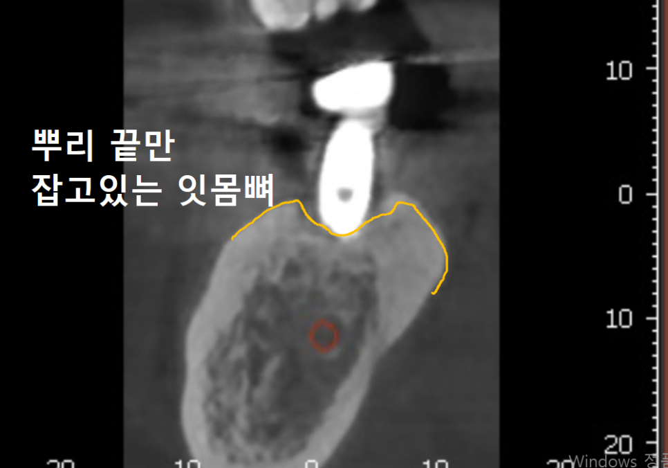 천호동 임플란트 재식립 사례, 평생 쓰는 줄 알았는데? 관련 이미지 9