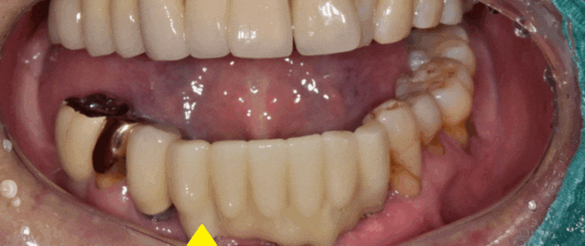 강동구 치과 앞니 흔들림 임플란트 케이스 관련 이미지 1
