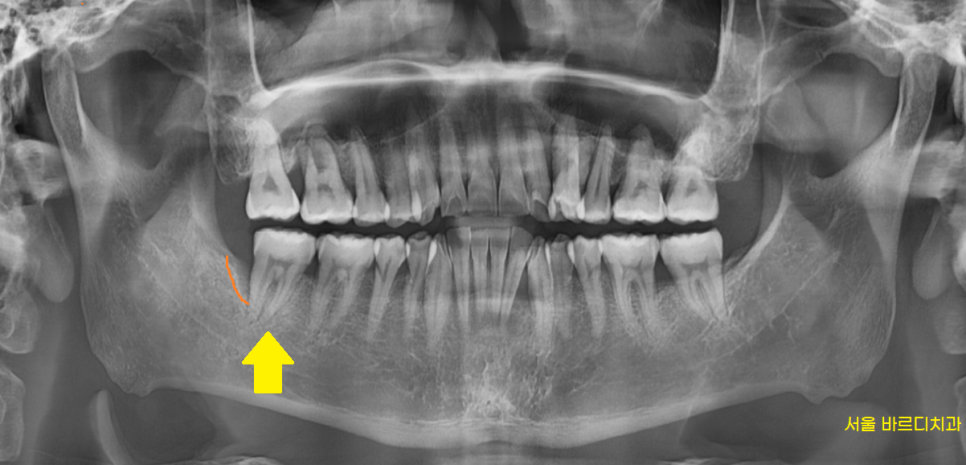 덕풍동 치과 잇몸 욱신 욱신 원인 찾아 임플란트 수술하였습니다. 관련 이미지 4
