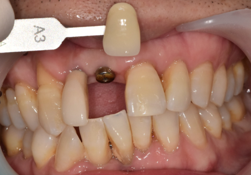 앞니 임플란트, 원내 기공소의 중요성을 아시나요? 관련 이미지 2