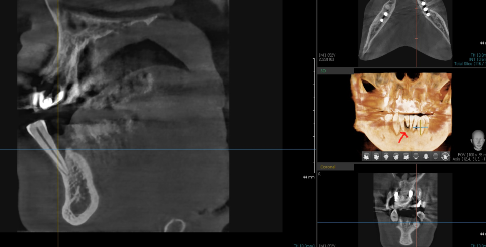 강동구 뼈이식 임플란트 과잉이라 생각하실 수 있지만 진실은 관련 이미지 4