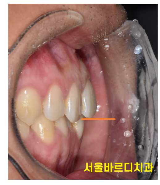 치아 교정 중 치간 삭제 치아를 깎는다고요??? 관련 이미지 4