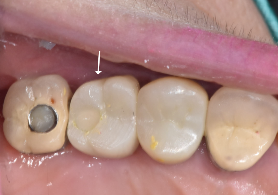 잇몸 고름 눌러보니 푹... 임플란트 주위염 방치했다가 재수술한 사례 관련 이미지 17