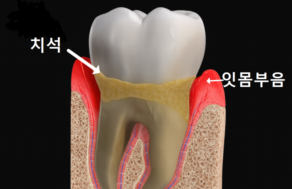 고덕동 아래 앞니 임플란트 비용 줄이는 비법, 공개합니다. 관련 이미지 2