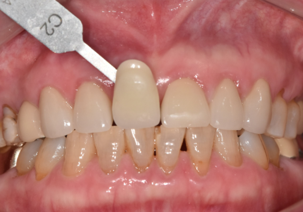 고덕동 앞니 보철, 브릿지와 싱글 크라운, 어떤 선택이 나에게 더 유리할까? 관련 이미지 18