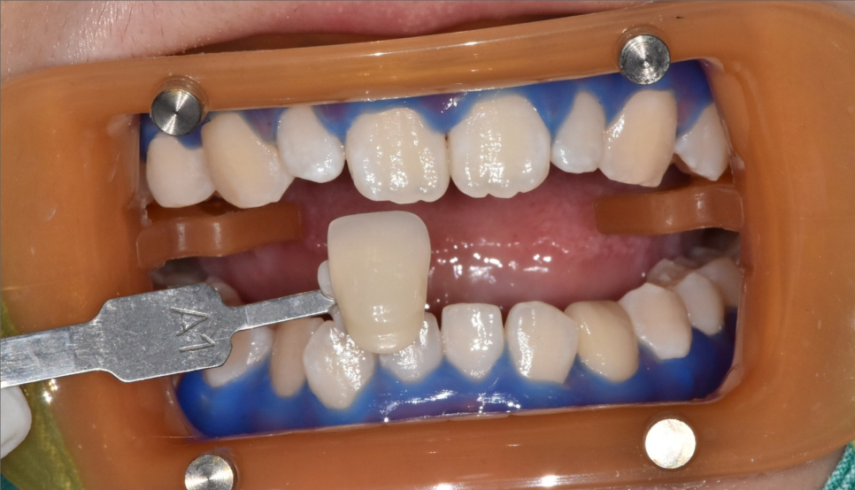 강동구 치아 미백 과정 확인하고 환한 미소로 웃어봐요 우리 관련 이미지 3